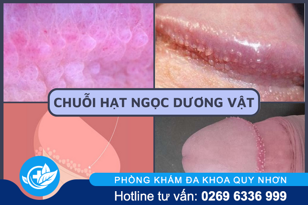 noi-mun-o-duong-vat-la-bi-gi-3