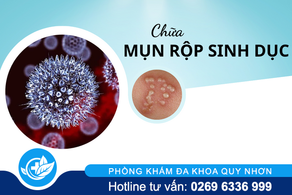 Phương pháp chữa mụn rộp sinh dục hiệu quả nhất hiện nay