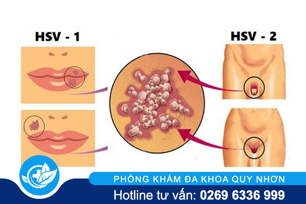 phuong-phap-chua-mun-rop-sinh-duc-hieu-qua-nhat-hien-nay-1