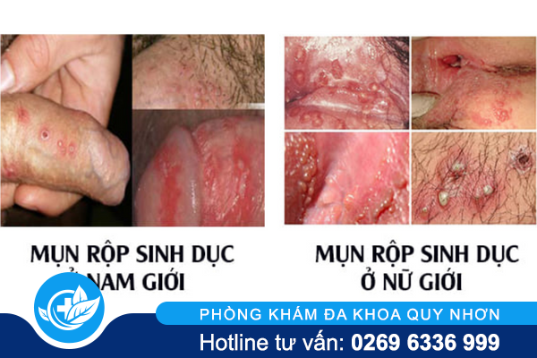 phuong-phap-chua-mun-rop-sinh-duc-hieu-qua-nhat-hien-nay-2