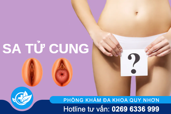 Sa tử cung và những thông tin đừng bỏ qua