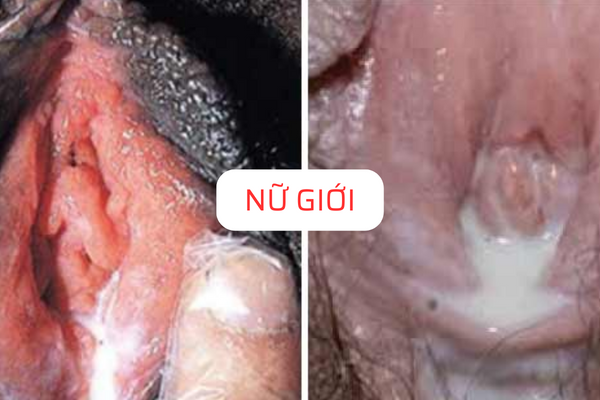 tong-hop-cac-su-that-ve-benh-lau-3