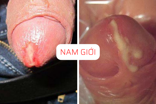 tong-hop-cac-su-that-ve-benh-lau-4