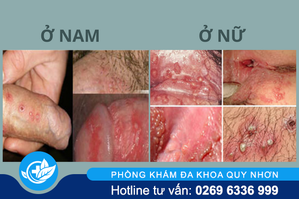 tong-hop-thong-tin-huu-ich-ve-mun-rop-sinh-duc-3