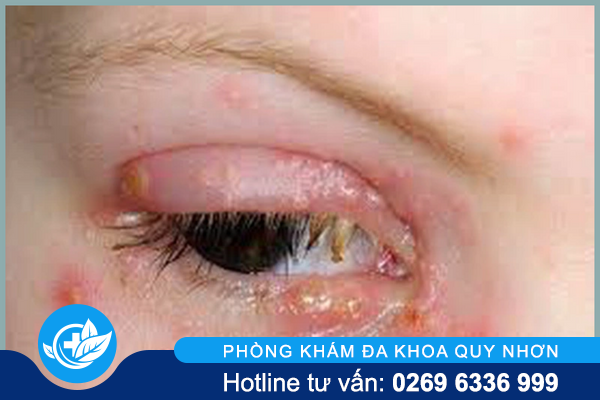 tong-hop-thong-tin-huu-ich-ve-mun-rop-sinh-duc-5