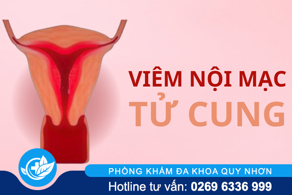 Đừng chủ quan với viêm mạc tử cung