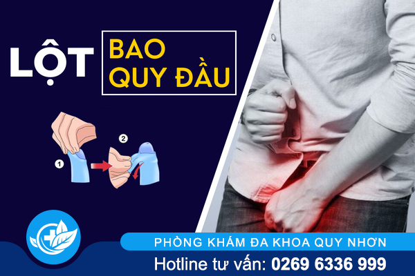 Cân nhắc trước khi lột bao quy đầu