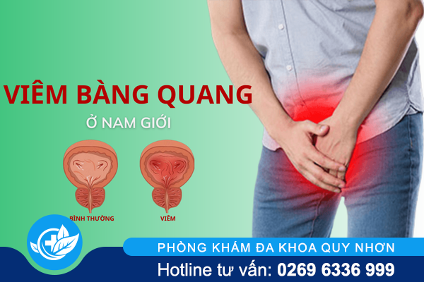 Chú ý căn bệnh viêm bàng quang ở nam giới