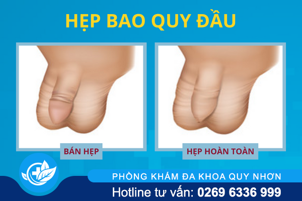diem-danh-cac-benh-o-bao-quy-dau-thuong-gap-02