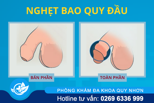 diem-danh-cac-benh-o-bao-quy-dau-thuong-gap-4