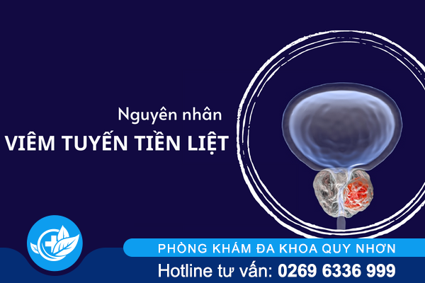 Điểm danh các nguyên nhân viêm tuyến tiền liệt