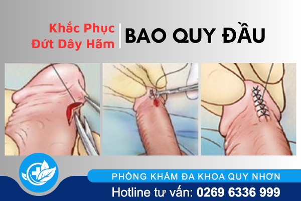 dut-day-ham-bao-quy-dau-khong-chi-la-tai-nan-nho-1