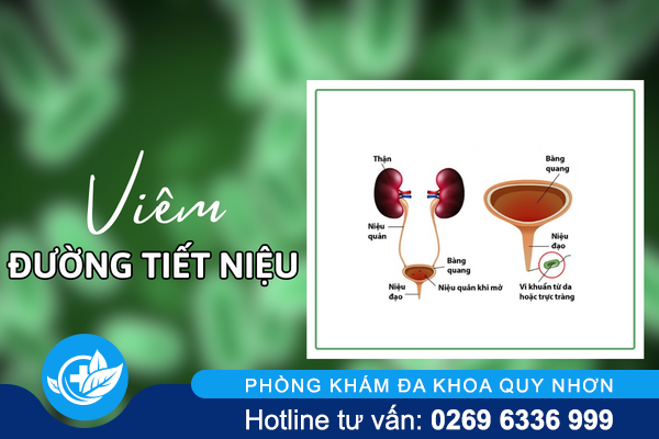 Viêm đường tiết niệu không trừ một ai