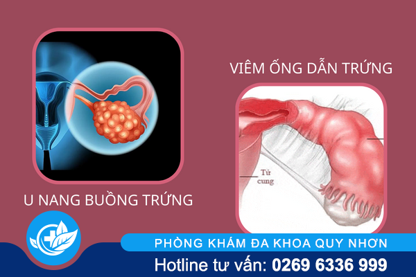 canh-bao-nguy-hiem-tu-con-dau-bung-duoi-o-nu-1