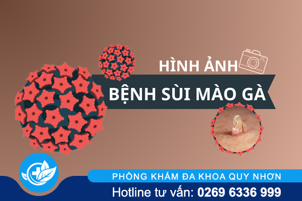 Hình ảnh bệnh sùi mào gà ở vị trí khác nhau trên cơ thể