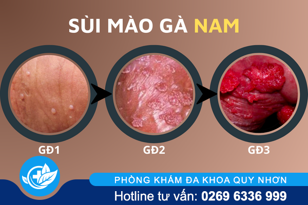 hinh-anh-benh-sui-mao-ga-o-vi-tri-khac-nhau-tren-co-the-2