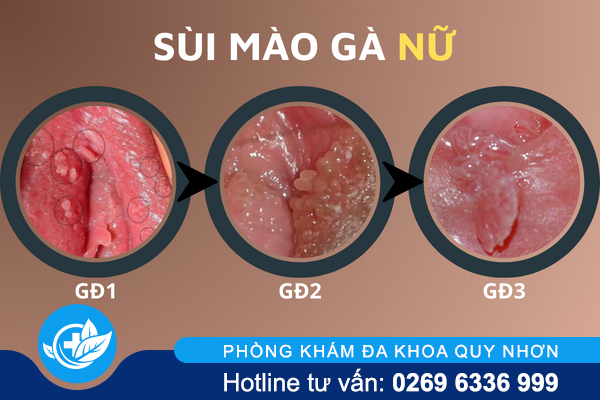 hinh-anh-benh-sui-mao-ga-o-vi-tri-khac-nhau-tren-co-the-3