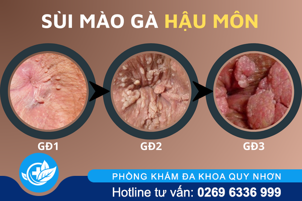 hinh-anh-benh-sui-mao-ga-o-vi-tri-khac-nhau-tren-co-the-4