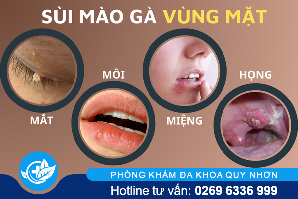 hinh-anh-benh-sui-mao-ga-o-vi-tri-khac-nhau-tren-co-the-5