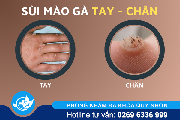 hinh-anh-benh-sui-mao-ga-o-vi-tri-khac-nhau-tren-co-the-6