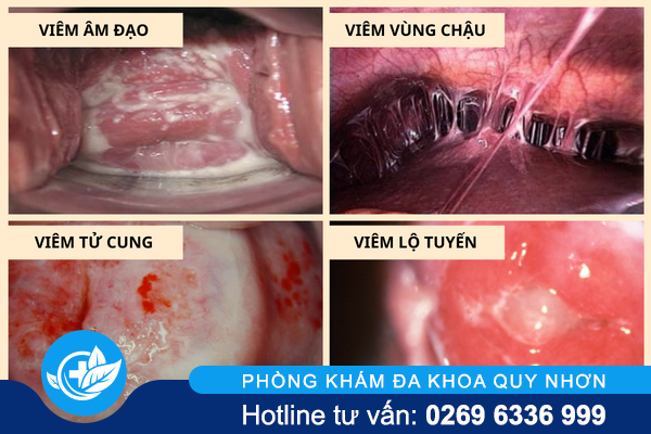 huyet-trang-mau-nau-dau-hieu-canh-bao-nguy-hiem-1