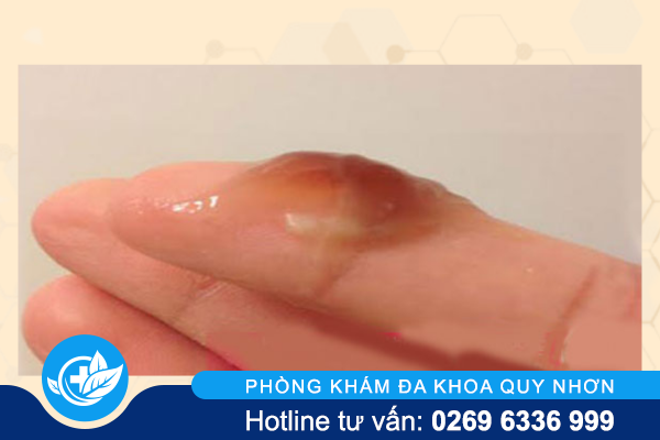 huyet-trang-mau-nau-dau-hieu-canh-bao-nguy-hiem-5