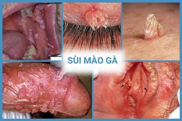 nhung-thong-tin-can-luu-y-ve-benh-xa-hoi-o-nam-va-nu-1