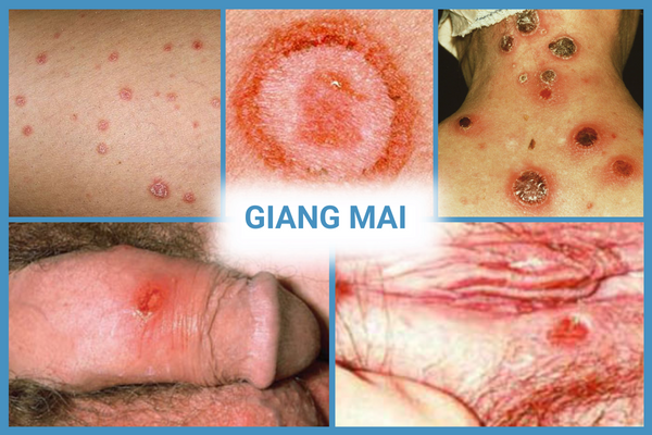 nhung-thong-tin-can-luu-y-ve-benh-xa-hoi-o-nam-va-nu-2