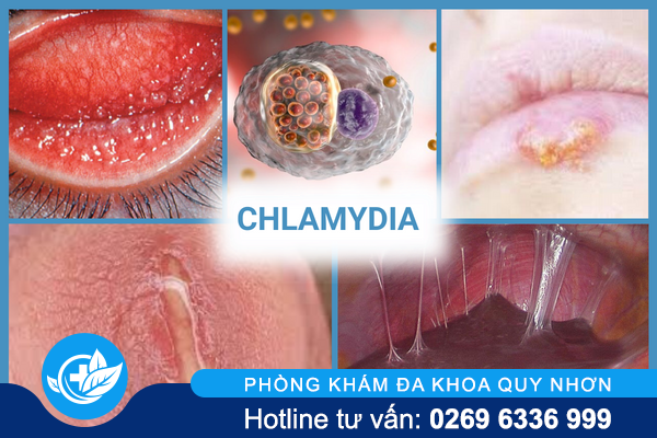 nhung-thong-tin-can-luu-y-ve-benh-xa-hoi-o-nam-va-nu-4