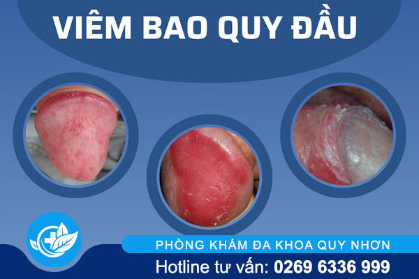 noi-mun-o-bao-quy-dau-nguyen-nhan-va-cach-giai-quyet-hieu-qua-1