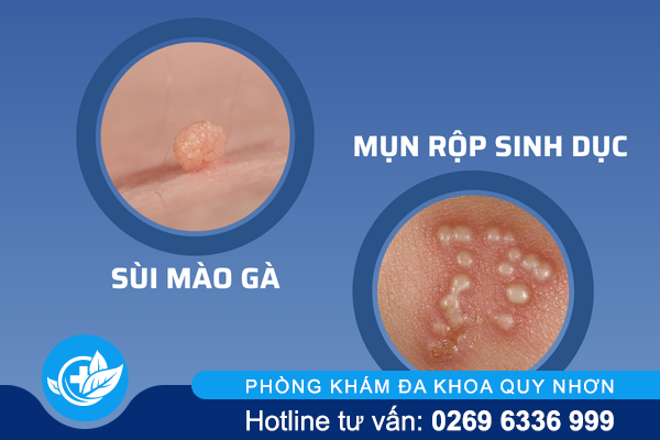 noi-mun-o-bao-quy-dau-nguyen-nhan-va-cach-giai-quyet-hieu-qua-3