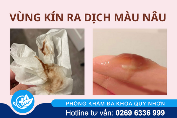 vung-kin-ra-dich-mau-nau-canh-bao-van-de-phu-khoa-1