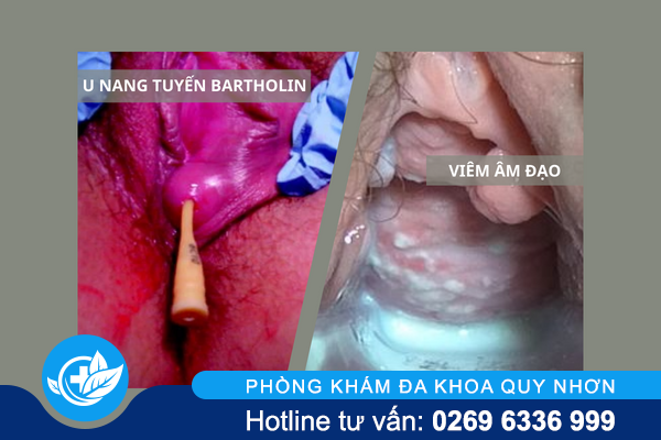 canh-bao-tinh-trang-noi-hach-o-mep-am-dao-1