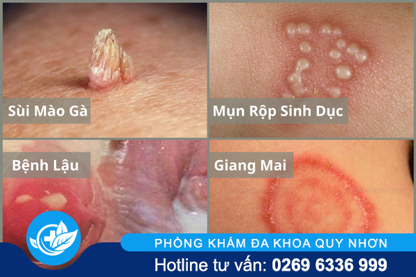 canh-bao-tinh-trang-noi-hach-o-mep-am-dao-2