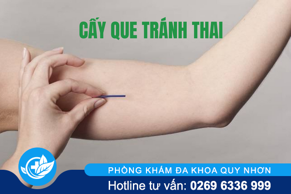 Bạn đang muốn cấy que tránh thai