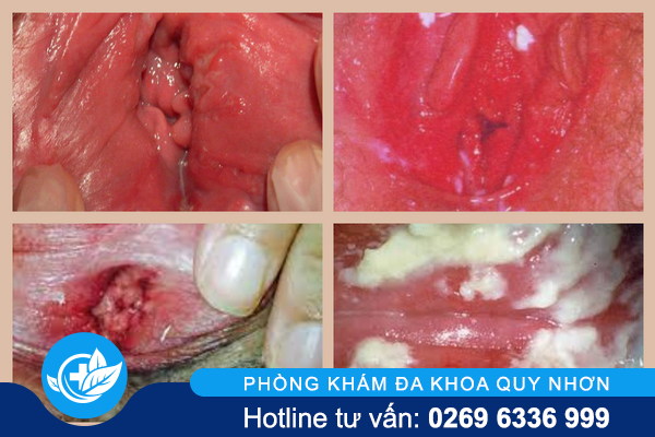 cach-chua-viem-am-dao-hieu-qua-toi-uu-1