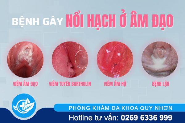 ly-do-bi-noi-hach-o-am-dao-va-cach-xu-ly-hieu-qua-1