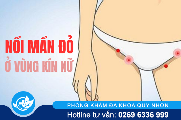 Nổi mẩn đỏ ở vùng kín nữ cảnh báo điều gì?