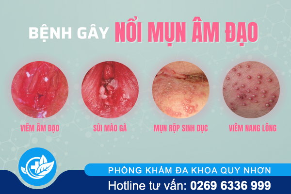 noi-mun-am-dao-la-bi-gi-va-dieu-tri-ra-sao-1