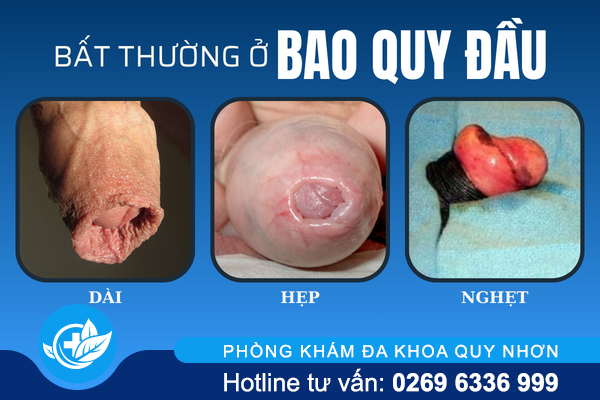 noi-mun-bao-quy-dau-canh-bao-dieu-gi-1