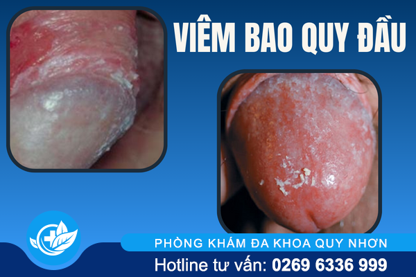 noi-mun-bao-quy-dau-canh-bao-dieu-gi-2