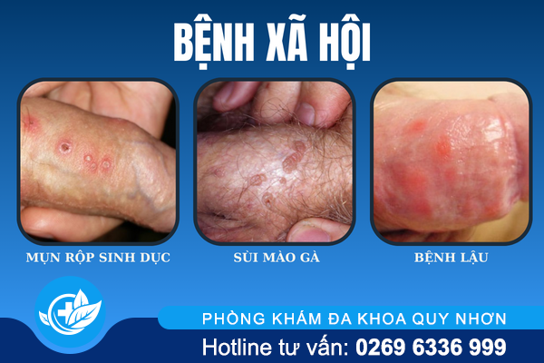 noi-mun-bao-quy-dau-canh-bao-dieu-gi-4