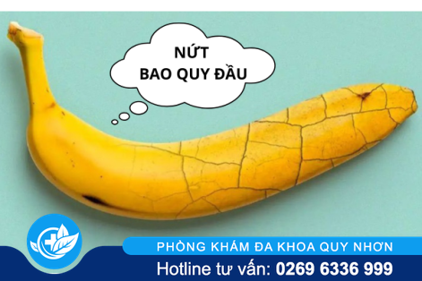 Sự thật về nứt bao quy đầu