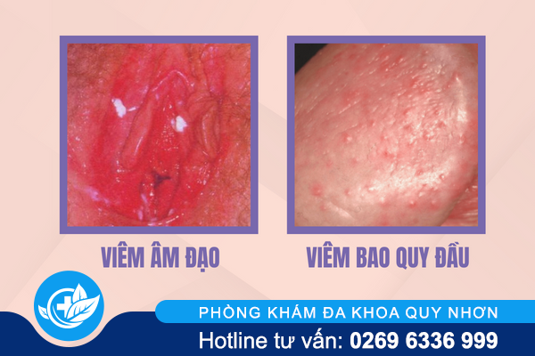 ly-do-dan-den-noi-mun-vung-kin-1