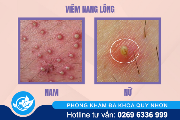 ly-do-dan-den-noi-mun-vung-kin-2