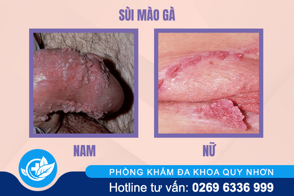 ly-do-dan-den-noi-mun-vung-kin-3