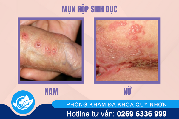 ly-do-dan-den-noi-mun-vung-kin-4