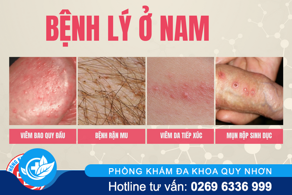 ngua-vung-kin-chi-don-do-kem-ve-sinh-1