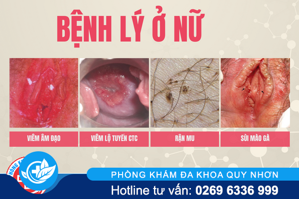 ngua-vung-kin-chi-don-do-kem-ve-sinh-2