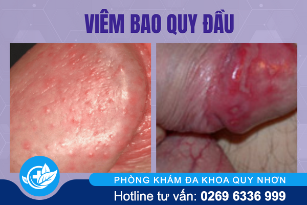 noi-man-ngua-vung-kin-la-do-dau-1